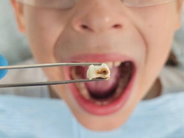 Best Emergency Wisdom Teeth Removal in Cerro Gordo, IL